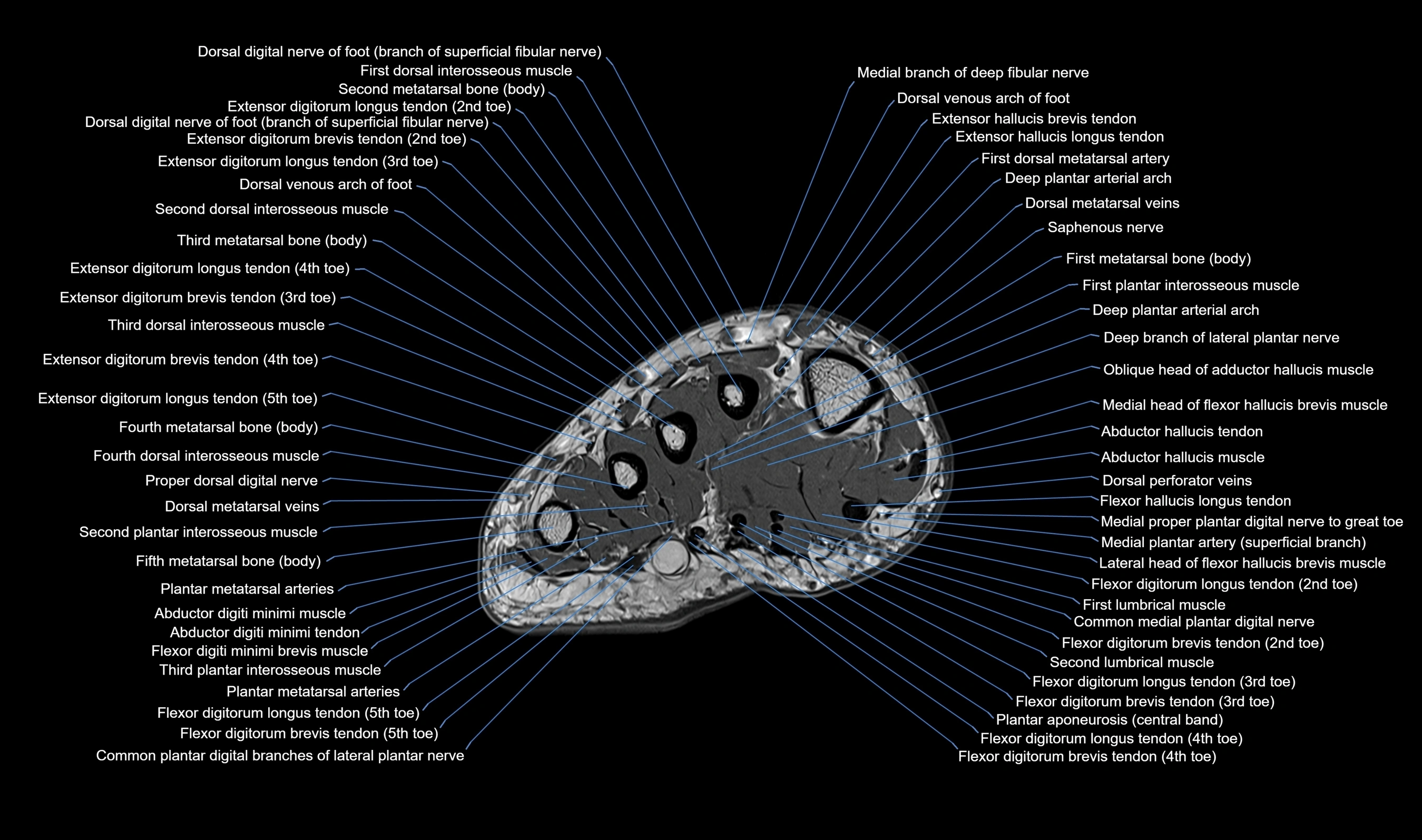 MRI mid foot axial cross sectional anatomy 3T  radiology  image-img-00001-00002.webp